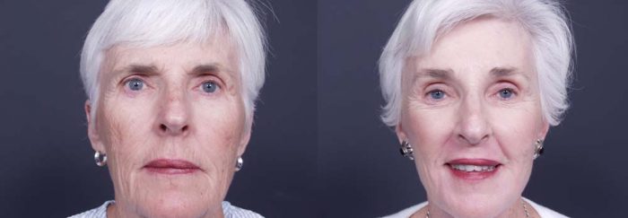 Facelift Patient 1a | Dr. Shaun Parson Plastic Surgery Scottsdale Arizona