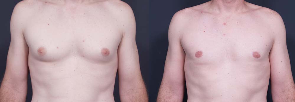 Gynecomastia Patient 3a | Dr. Shaun Parson Plastic Surgery Scottsdale Arizona