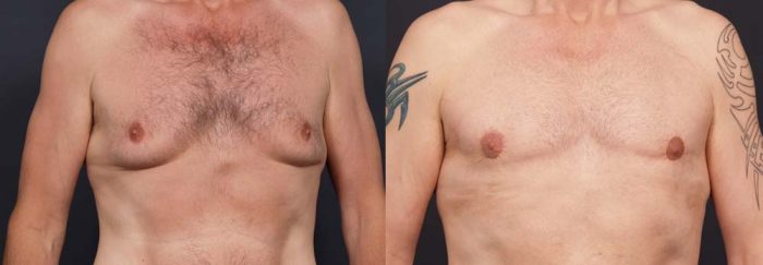 Gynecomastia Patient 5a | Dr. Shaun Parson Plastic Surgery Scottsdale Arizona