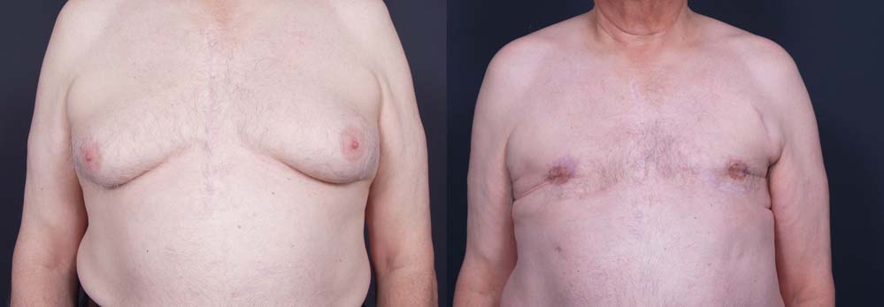 Gynecomastia Patient 6 | Dr. Shaun Parson Plastic Surgery Scottsdale Arizona