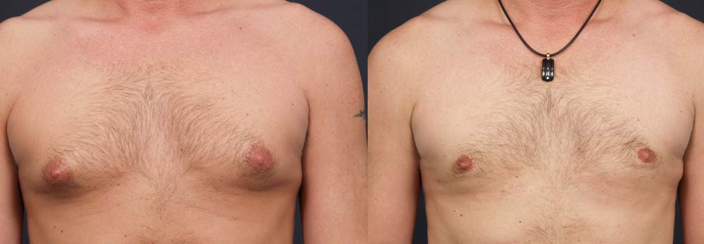 Gynecomastia Patient 7a | Dr. Shaun Parson Plastic Surgery Scottsdale Arizona