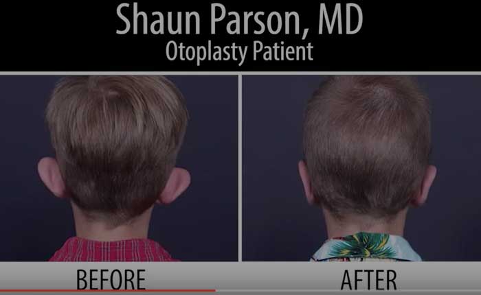 Otoplasty | Dr. Shaun Parson Plastic Surgery Scottsdale