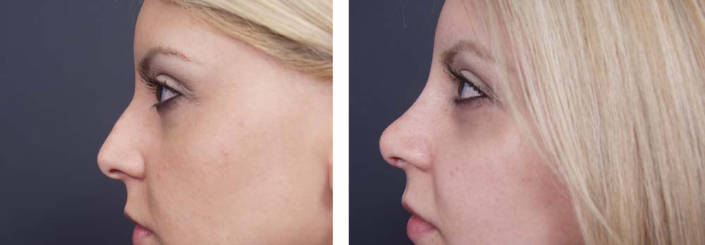 Rhinoplasty Patient 1a | Dr. Shaun Parson Plastic Surgery Scottsdale Arizona