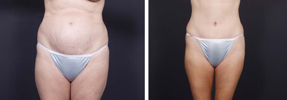 Tummy Tuck Patient 11a | Dr. Shaun Parson Plastic Surgery Scottsdale Arizona