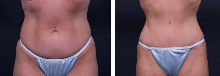 Tummy Tuck Patient 12a | Dr. Shaun Parson Plastic Surgery Scottsdale Arizona