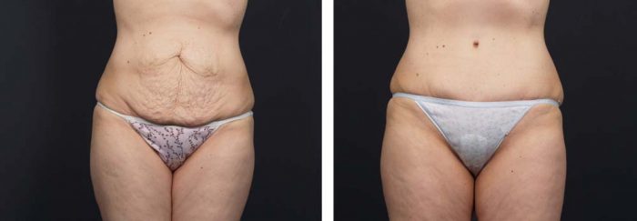 Tummy Tuck Patient 14a | Dr. Shaun Parson Plastic Surgery Scottsdale Arizona