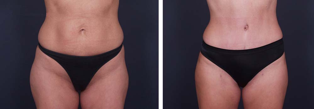 Tummy Tuck Patient 1a | Dr. Shaun Parson Plastic Surgery Scottsdale Arizona