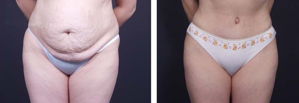 Tummy Tuck Patient 4a | Dr. Shaun Parson Plastic Surgery Scottsdale Arizona