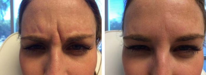 Botox and Filler Patient 2 | Dr. Shaun Parson Plastic Surgery Scottsdale Arizona