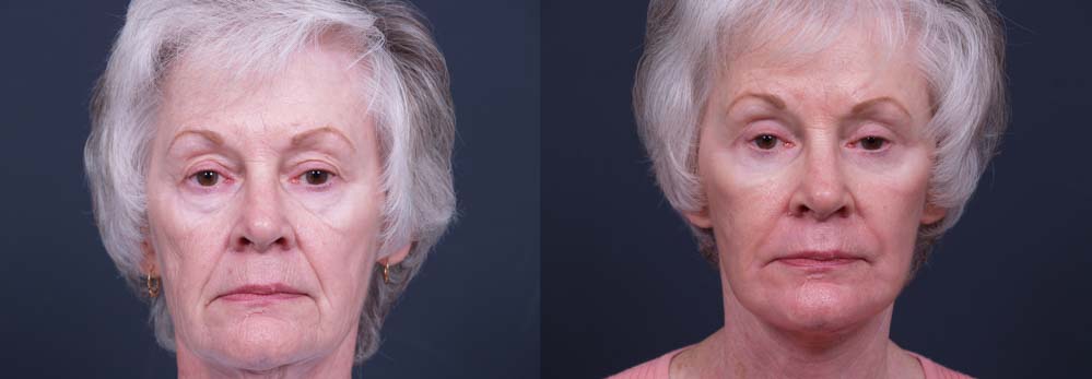 facelift patient 3a | Dr. Shaun Parson Plastic Surgery Scottsdale Arizona