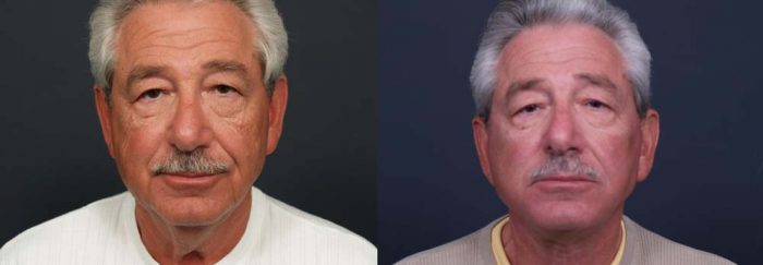 facelift patient 4a | Dr. Shaun Parson Plastic Surgery Scottsdale Arizona