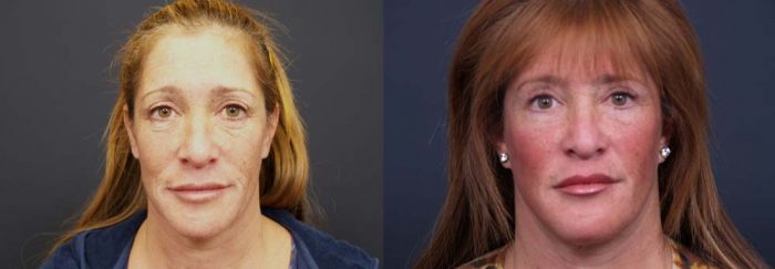 facelift patient 8a | Dr. Shaun Parson Plastic Surgery Scottsdale Arizona