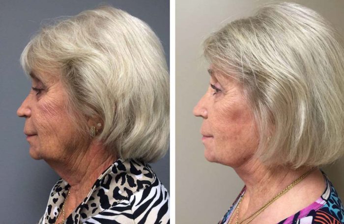 facelift9 | Dr. Shaun Parson Plastic Surgery Scottsdale Arizona