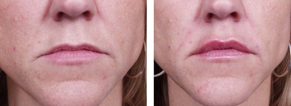 Dermal Filler Patient 3 | Dr. Shaun Parson Plastic Surgery Scottsdale Arizona