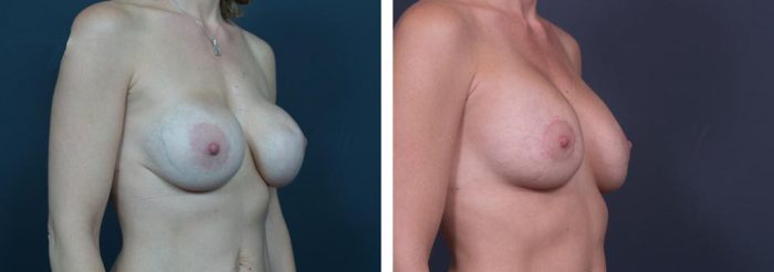 Breast Revision Patient 1 | Dr. Shaun Parson Plastic Surgery, Scottsdale, Arizona