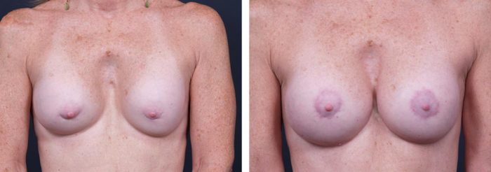 Breast Revision Patient 2 | Dr. Shaun Parson Plastic Surgery, Scottsdale, Arizona