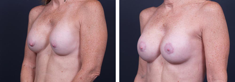 Breast Revision Patient 2 | Dr. Shaun Parson Plastic Surgery, Scottsdale, Arizona