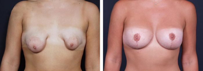 Breast Revision Patient 3 | Dr. Shaun Parson Plastic Surgery, Scottsdale, Arizona