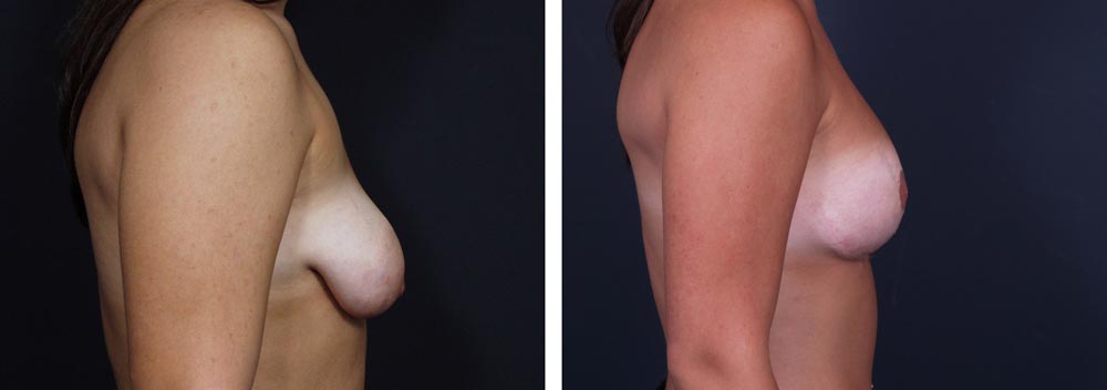 Breast Revision Patient 3 | Dr. Shaun Parson Plastic Surgery, Scottsdale, Arizona