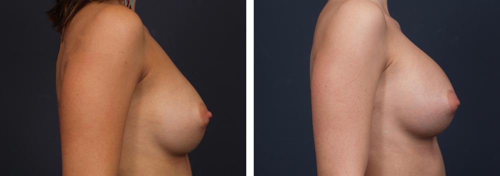 Breast Revision Patient 4 | Dr. Shaun Parson Plastic Surgery, Scottsdale, Arizona