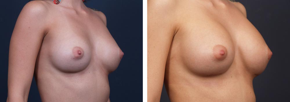 Breast Revision Patient 4 | Dr. Shaun Parson Plastic Surgery, Scottsdale, Arizona