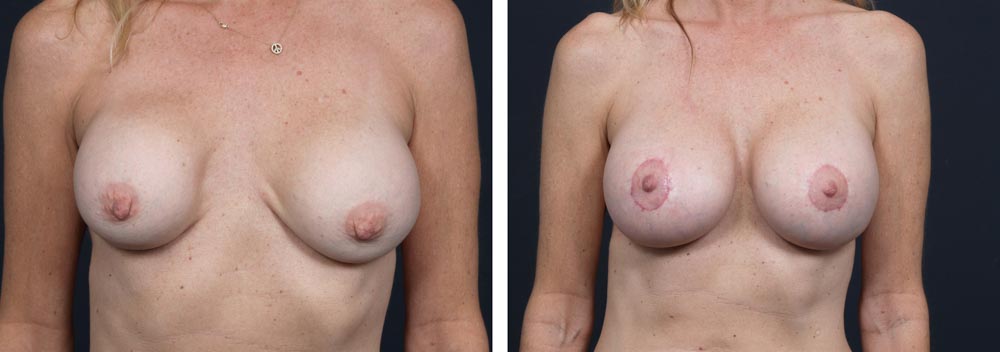 Breast Revision Patient 5 | Dr. Shaun Parson Plastic Surgery, Scottsdale, Arizona