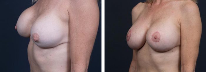 Breast Revision Patient 5 | Dr. Shaun Parson Plastic Surgery, Scottsdale, Arizona