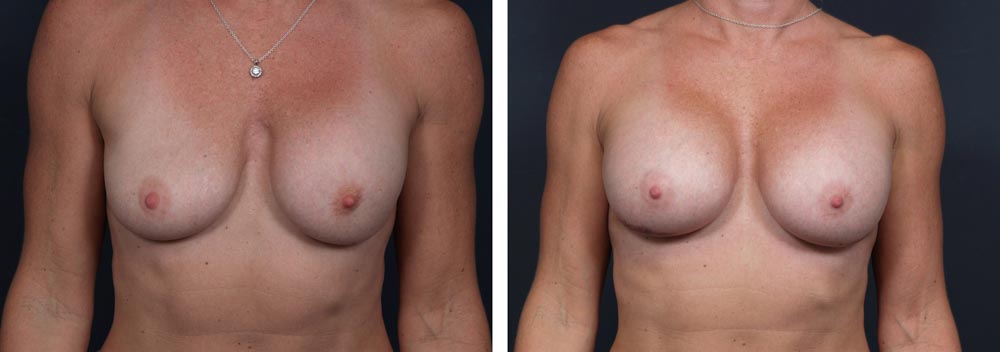 Breast Revision Patient 6 | Dr. Shaun Parson Plastic Surgery, Scottsdale, Arizona