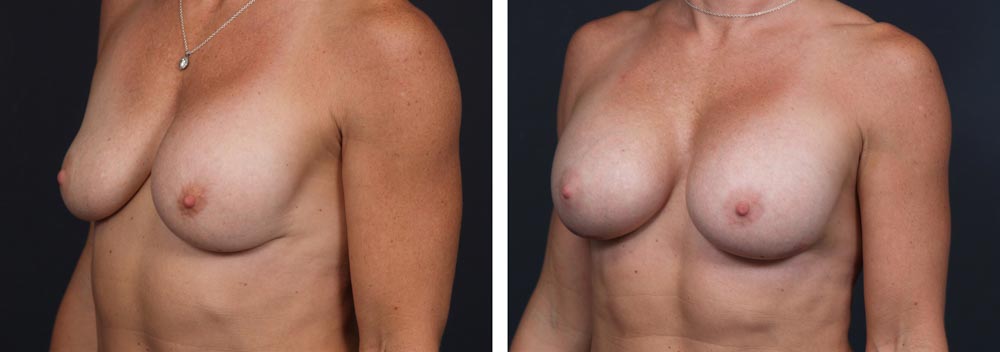 Breast Revision Patient 6 | Dr. Shaun Parson Plastic Surgery, Scottsdale, Arizona