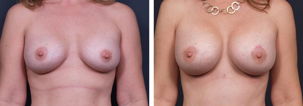 Breast Revision Patient 7 | Dr. Shaun Parson Plastic Surgery, Scottsdale, Arizona