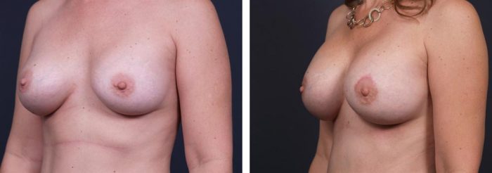 Breast Revision Patient 7 | Dr. Shaun Parson Plastic Surgery, Scottsdale, Arizona