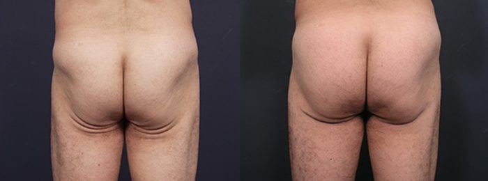 Butt Lift Patient 3 | Dr. Shaun Parson Plastic Surgery, Scottsdale, Arizona