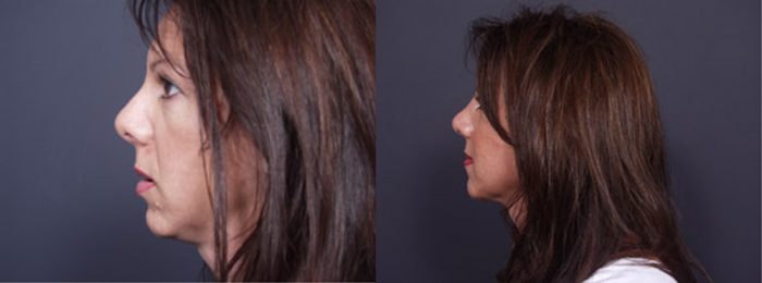 Chin Implant Patient 5 | Dr. Shaun Parson Plastic Surgery, Scottsdale, Arizona