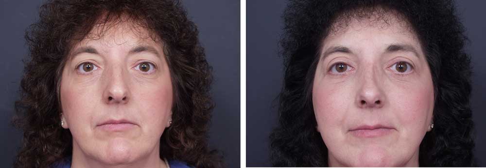 Rhinoplasty Patient 3 | Dr. Shaun Parson Plastic Surgery, Scottsdale, Arizona