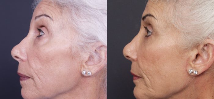 Chin Implant Patient 6 | Dr. Shaun Parson Plastic Surgery, Scottsdale, Arizona