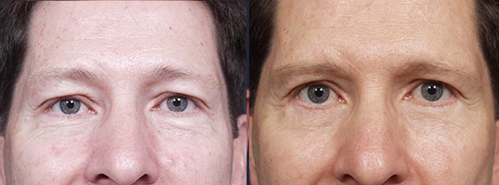 Eyelid Surgery Patient 6 | Dr. Shaun Parson Plastic Surgery, Scottsdale, Arizona