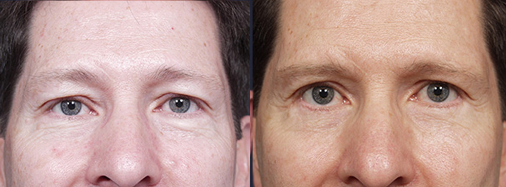 Eyelid Surgery Patient 6 | Dr. Shaun Parson Plastic Surgery, Scottsdale, Arizona