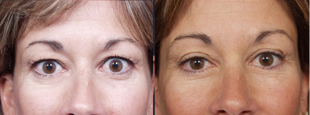 Eyelid Surgery Patient 11 | Dr. Shaun Parson Plastic Surgery, Scottsdale, Arizona