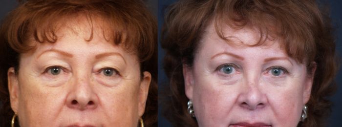 Eyelid Surgery Patient 13 | Dr. Shaun Parson Plastic Surgery, Scottsdale, Arizona