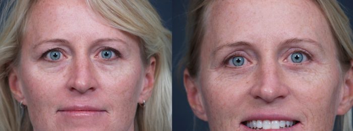 Eyelid Surgery Patient 14 | Dr. Shaun Parson Plastic Surgery, Scottsdale, Arizona