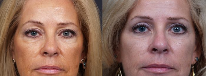 Eyelid Surgery Patient 15 | Dr. Shaun Parson Plastic Surgery, Scottsdale, Arizona