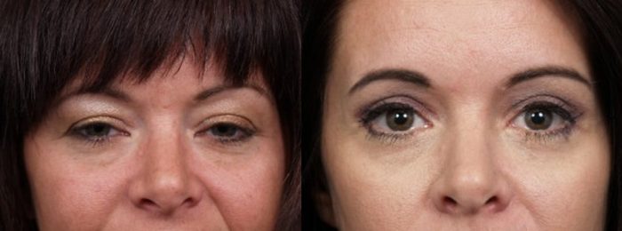 Eyelid Surgery Patient 16 | Dr. Shaun Parson Plastic Surgery, Scottsdale, Arizona