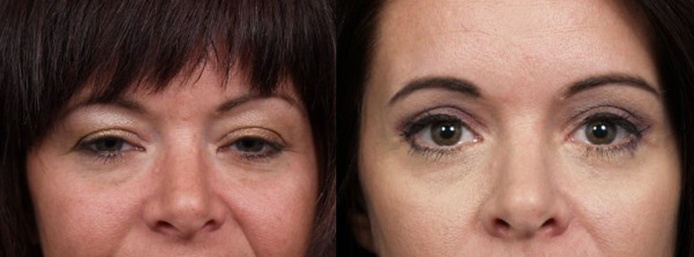 Eyelid Surgery Patient 16 | Dr. Shaun Parson Plastic Surgery, Scottsdale, Arizona