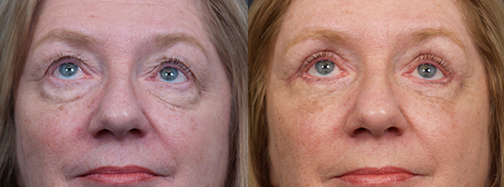 Eyelid Surgery Patient 17 | Dr. Shaun Parson Plastic Surgery, Scottsdale, Arizona