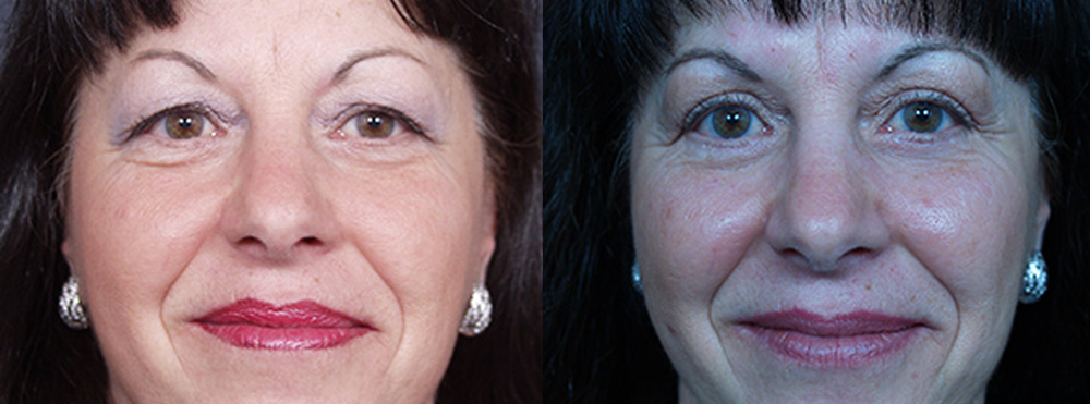 Eyelid Surgery Patient 18 | Dr. Shaun Parson Plastic Surgery, Scottsdale, Arizona