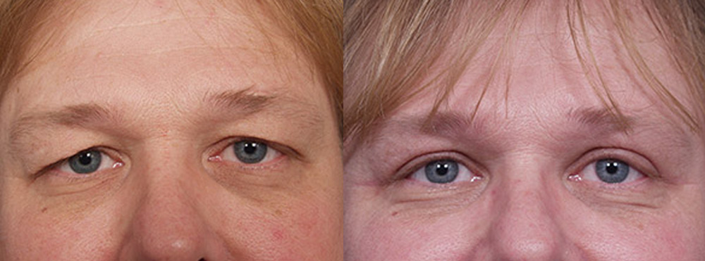 Eyelid Surgery Patient 6 | Dr. Shaun Parson Plastic Surgery, Scottsdale, Arizona