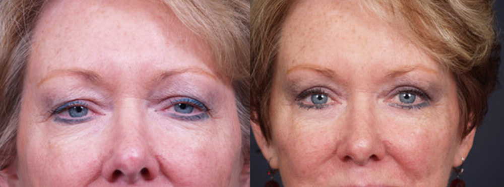 Eyelid Surgery Patient 7 | Dr. Shaun Parson Plastic Surgery, Scottsdale, Arizona