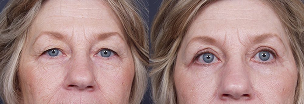 Eyelid Surgery Patient 8 | Dr. Shaun Parson Plastic Surgery, Scottsdale, Arizona