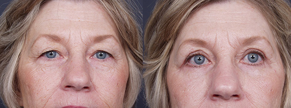 Eyelid Surgery Patient 8 | Dr. Shaun Parson Plastic Surgery, Scottsdale, Arizona