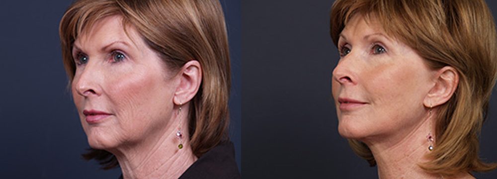 Facelift Patient 10 | Dr. Shaun Parson Plastic Surgery, Scottsdale, Arizona